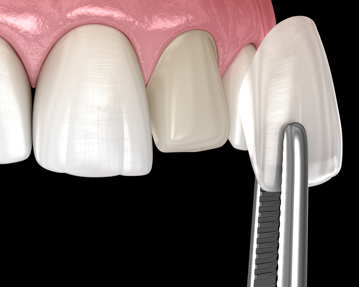 Veneer installation procedure over central incisor. Medically accurate tooth 3D illustration