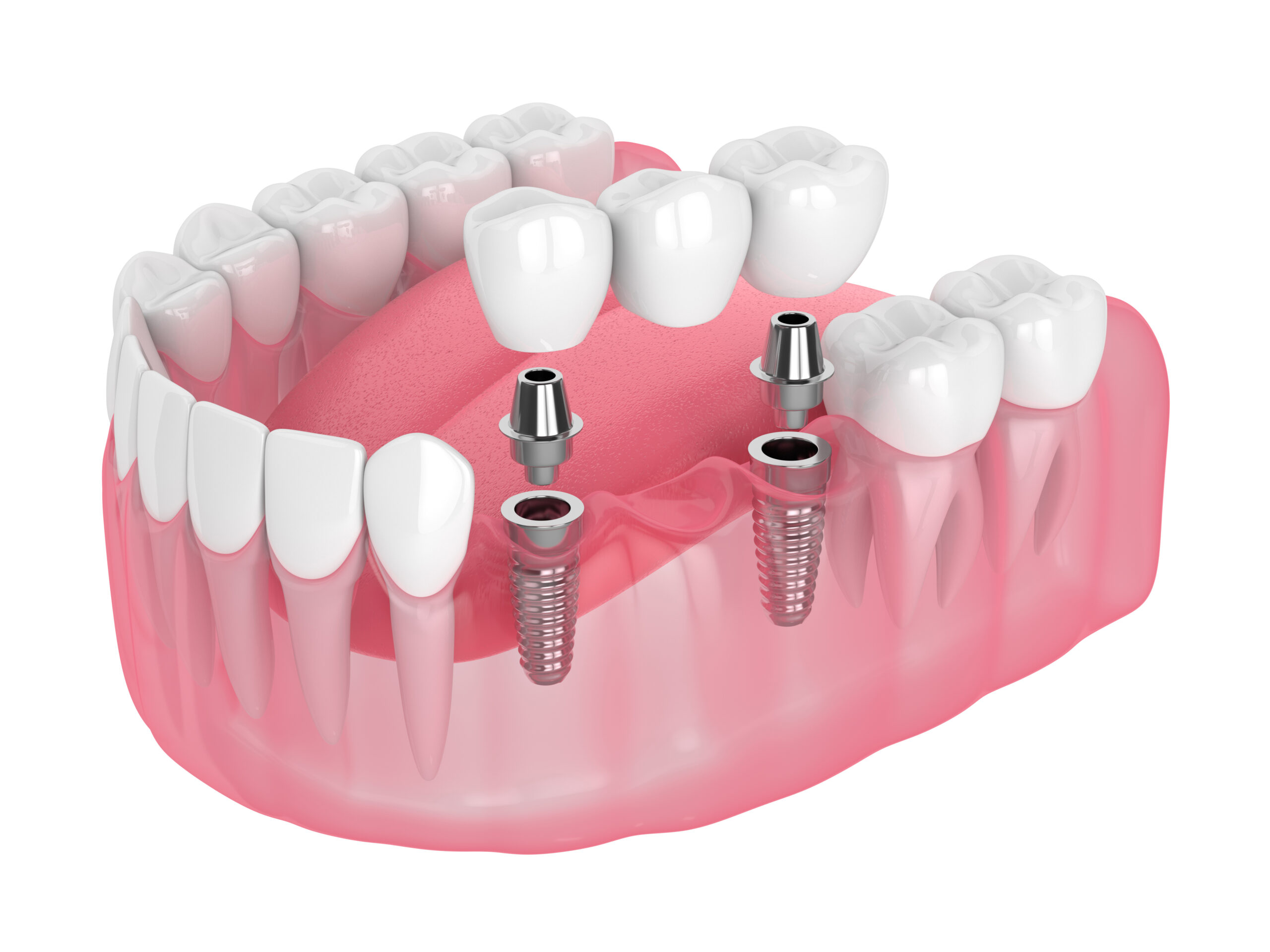 3d render of jaw with implants supported dental bridge isolated over white background