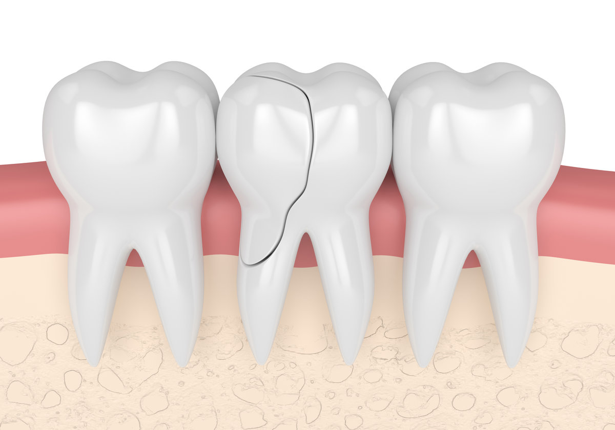 3d render of gums with treatable cracked tooth over white background. Fractured cusps. Different types of broken teeth concept.