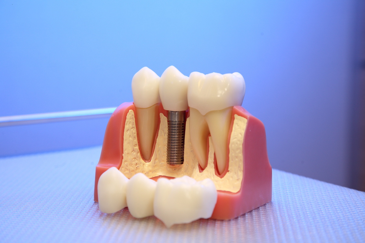 dental implant, model, plate, denture. Dental implant, artificial tooth roots into jaw, root canal of dental treatment, gum disease, teeth model for dentist studying about dentistry.