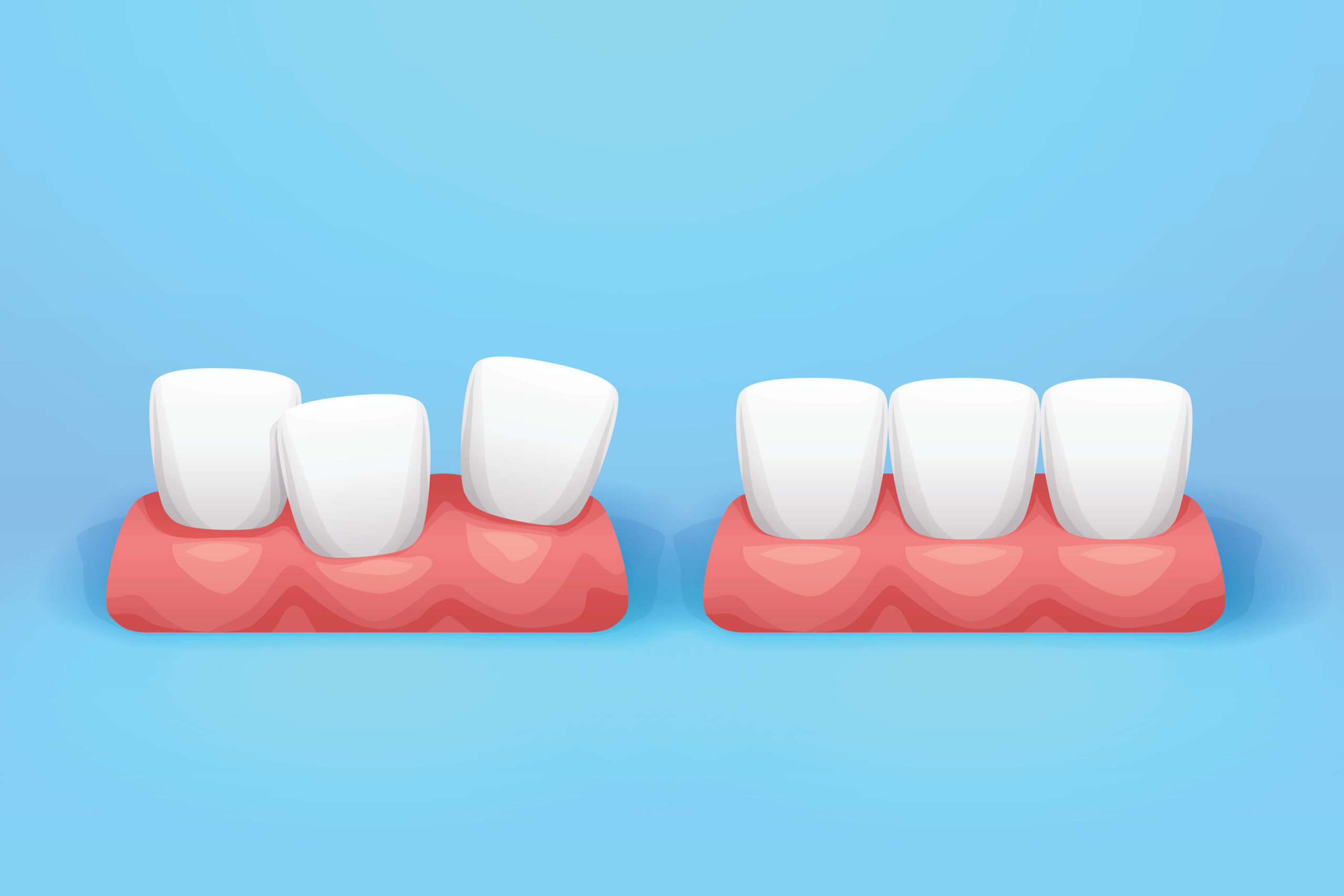 straight and crooked teeth on blue back